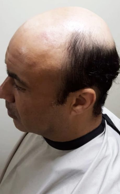 Cliente de perfil antes da prótese capilar, com calvície no topo da cabeça