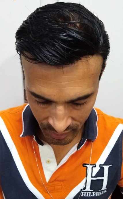 Mesmo cliente depois da prótese capilar, com cabelo cheio e linha frontal natural