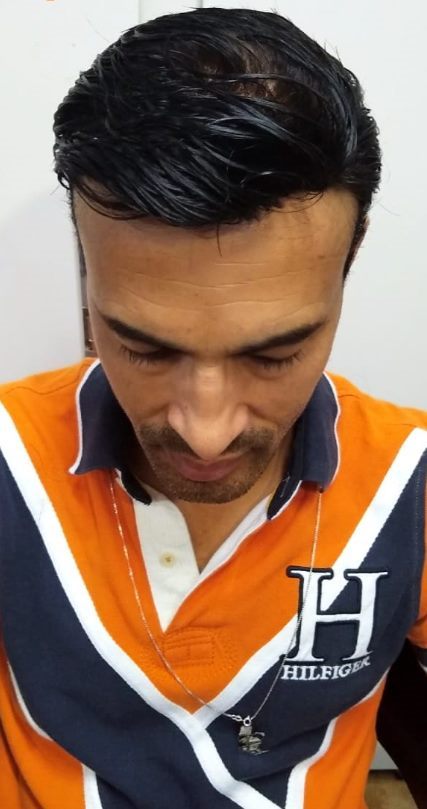 Resultado de prótese capilar: cabelo cheio com linha frontal natural